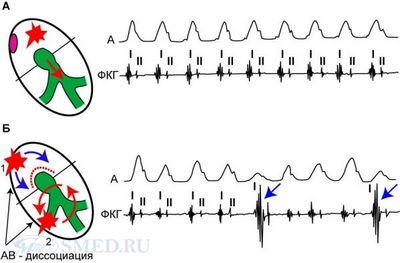 дефибриллятора