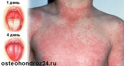 скарлатина