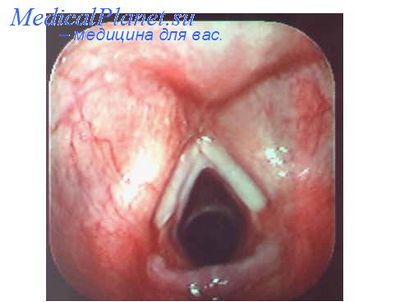 гортанного рака