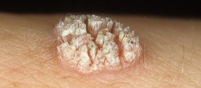 шистосомоз