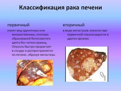 рака печени