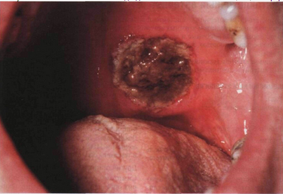 гранулематоз