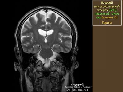 мотонейрона