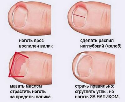 Нарывает палец возле ногтя на ноге ребенка Нарывает палец возле ногтя на ноге ребенка