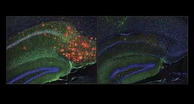 Исследование показало, что холестерин способствует образованию бляшек Альцгеймера