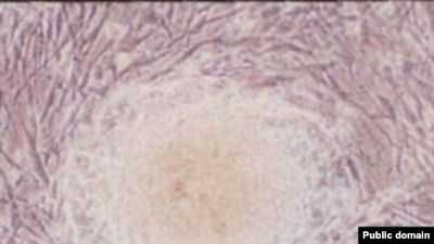 Первое испытание безопасности терапии эмбриональными стволовыми клетками у пациентов из Азии