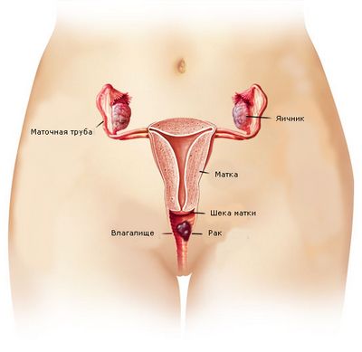 влагалищного рака