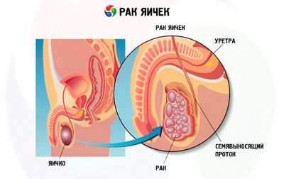 тестикулярного рака