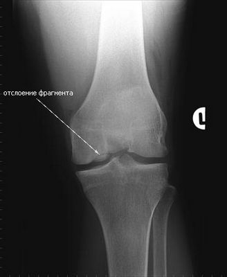 osteochondritis