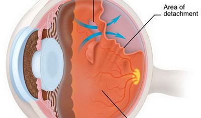 отслоение сетчатки