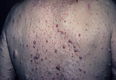 нейрофиброматоз