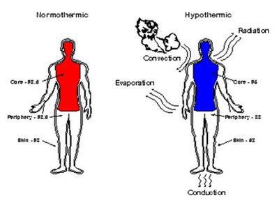 гипотермия