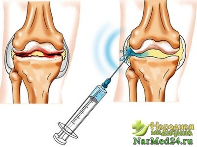 остеомиелит