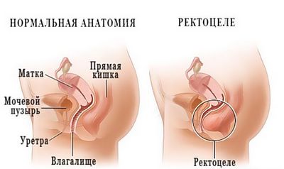 ректоцеле