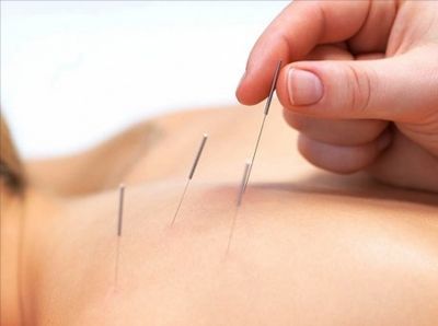 иглоукалывания