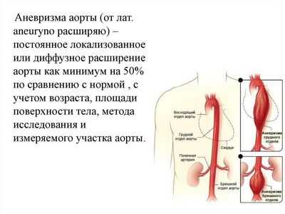 Исследователи разрабатывают методику прогнозирования опасного роста аневризм брюшной аорты