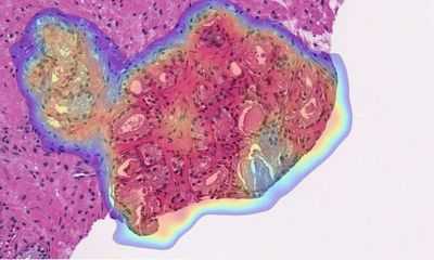 Искусственный интеллект идентифицирует рак простаты с почти идеальной точностью