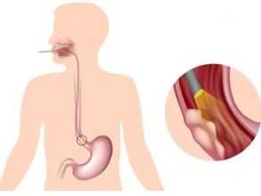 Новый минимально инвазивный тест определяет пациентов для скрининга пищевода Барретта
